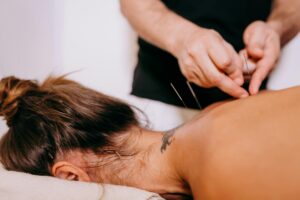 Needling at Langley Sports and Rehab.