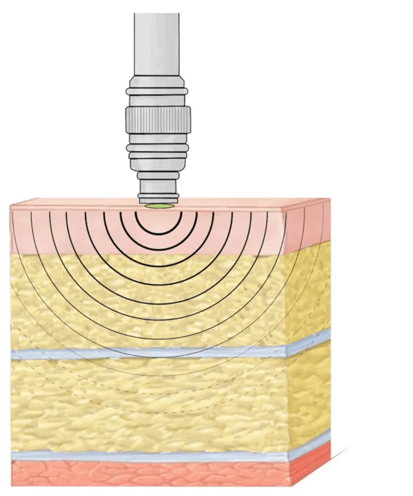 Shockwave Therapy in Maple