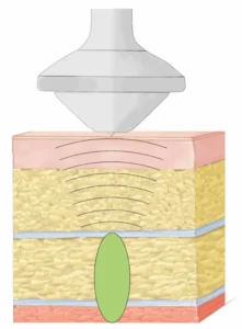 shockwave Treatment in Langley