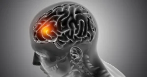 post-concussion syndrome